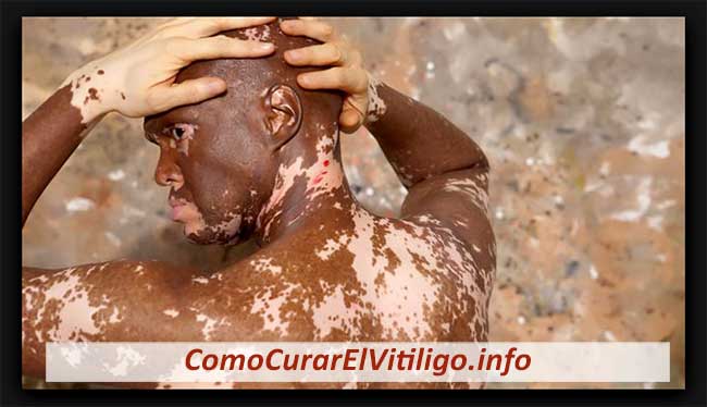 Síntomas de Vitiligo